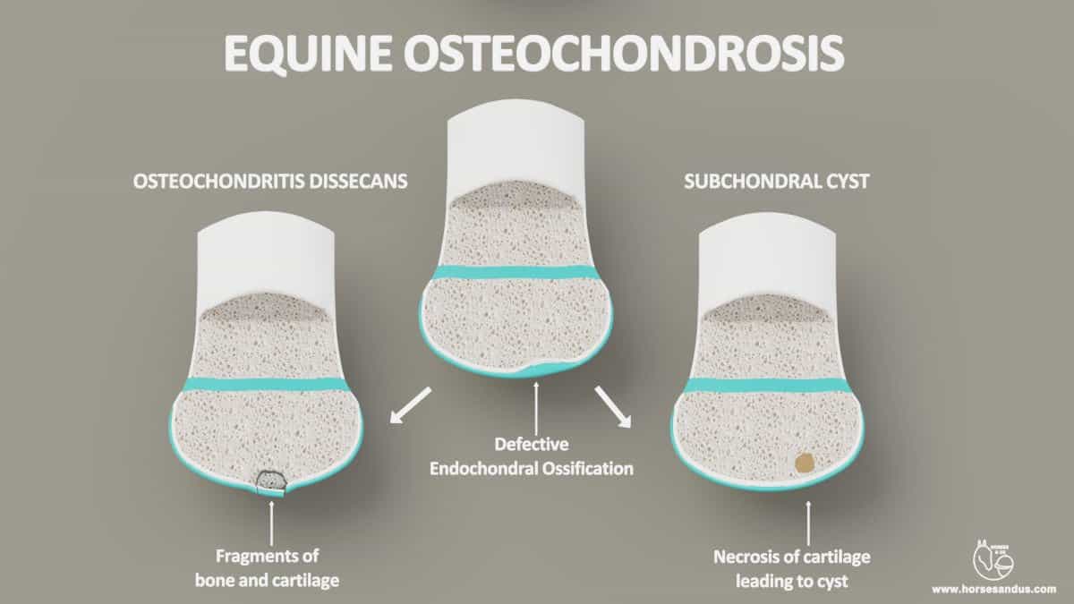 Osteochondritis dissecans and subchondral cysts