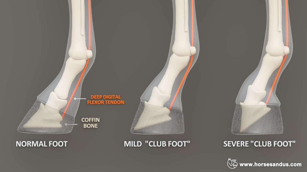 Equine Flexural limb deformity - Club foot (normal hoof, mild club foot, severe club foot)