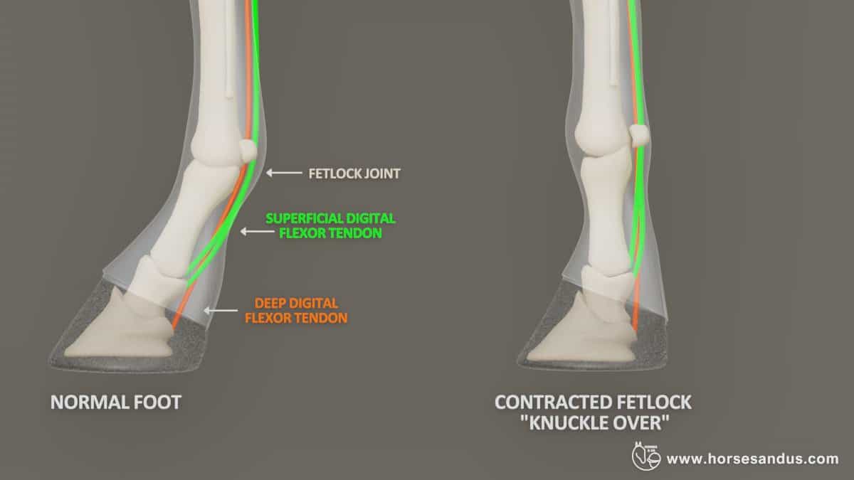 Equine Flexural limb deformity - contracted fetlock(knuckle over))
